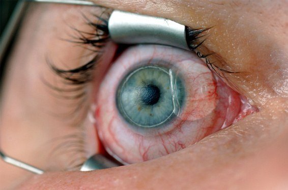 Göz Lazer Ameliyatı Nedir